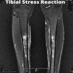 Tibial-Stress-Reaction
