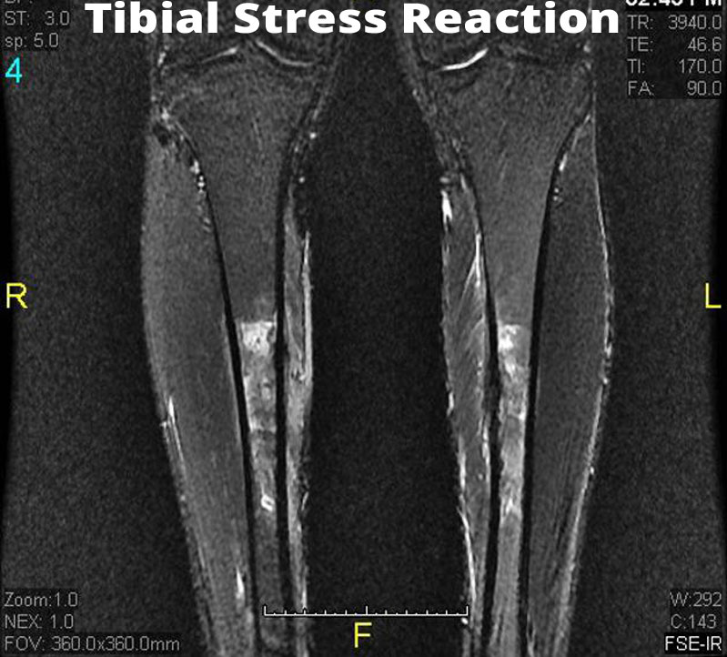 Tibial-Stress-Reaction